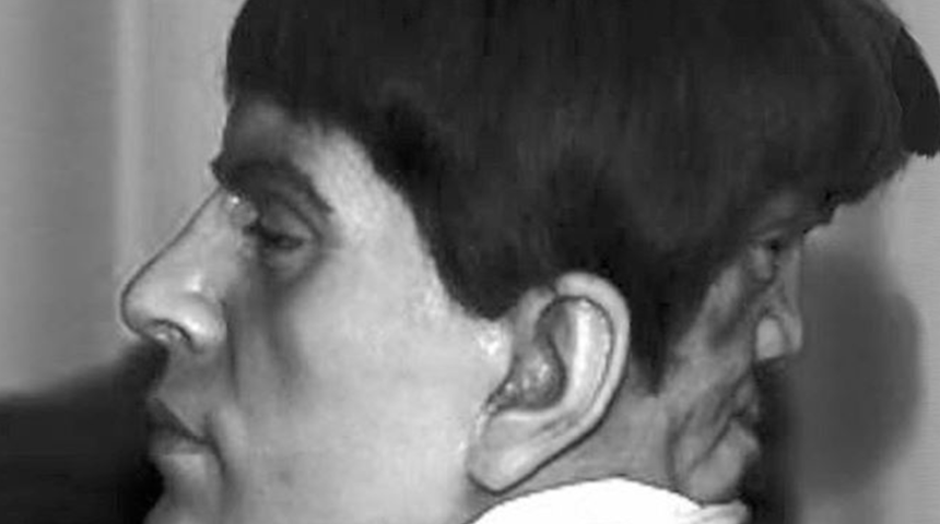 Kafasının arkasında başka bir yüzle doğan ve fısıltılar nedeniyle delirdiği söylenen bir adam: Edward Mordake