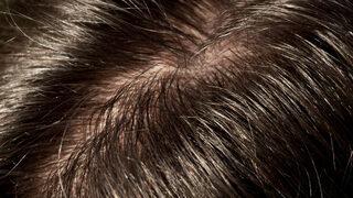 Yağlı saçlardan sıkıldınız mı? Korkmayın, kurtulmak çok basit!