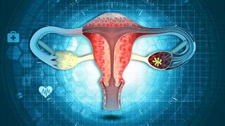 Miyom belirtileri nelerdir? Sessizce ilerliyor, kısırlığa bile sebep oluyor