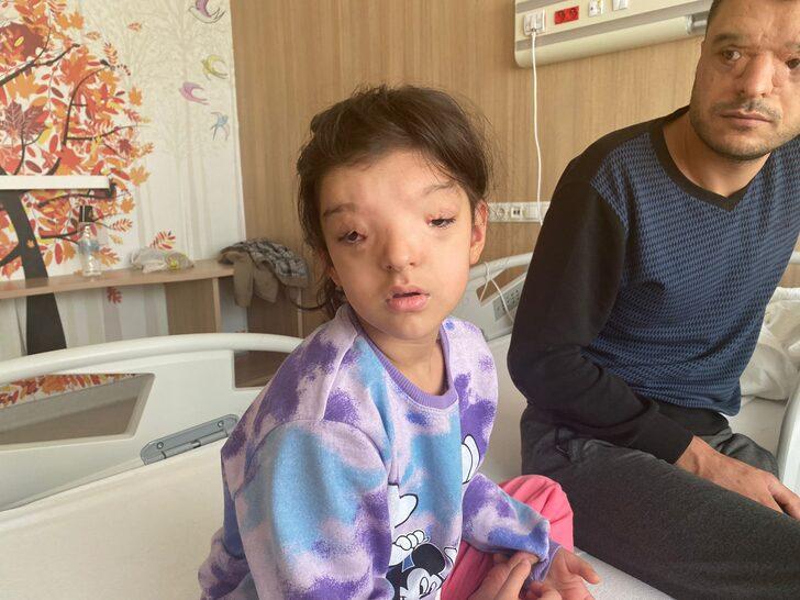 Dünyada sadece 4 ailede görülüyordu! Gözleri arasındaki mesafe 3 santimetreye düşürüldü G3