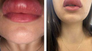 Uyurken kırkayak üst dudağını ısırdı! Uyandığında gördükleri karşısında şaşkına döndü