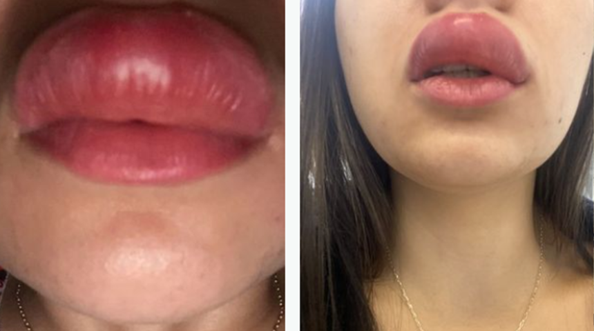 Uyurken kırkayak üst dudağını ısırdı! Uyandığında gördükleri karşısında şaşkına döndü