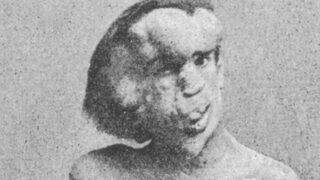 Dramatik hikâyesi ile filmlere konu oldu! Hastalığı yüzyıllar sonrasında keşfedilen insan: Joseph Merrick