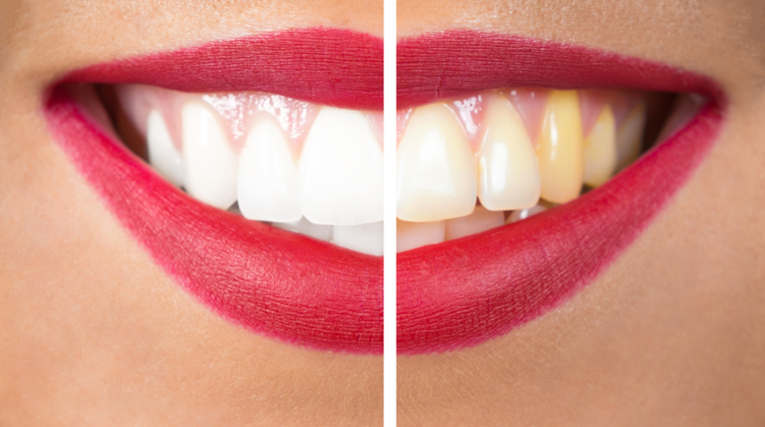 Diş temizletme zararlı mıdır?