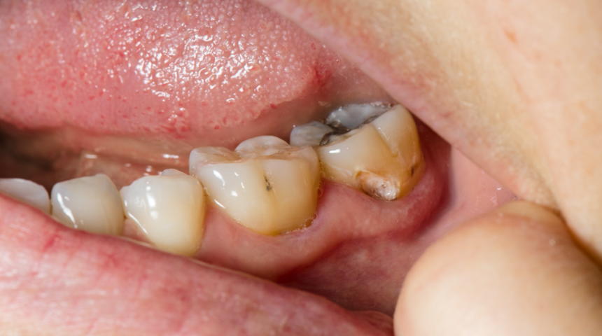 Diş çürüklerini tespit etmede dondurmanın rolü