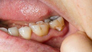 Diş çürüklerini tespit etmede dondurmanın rolü