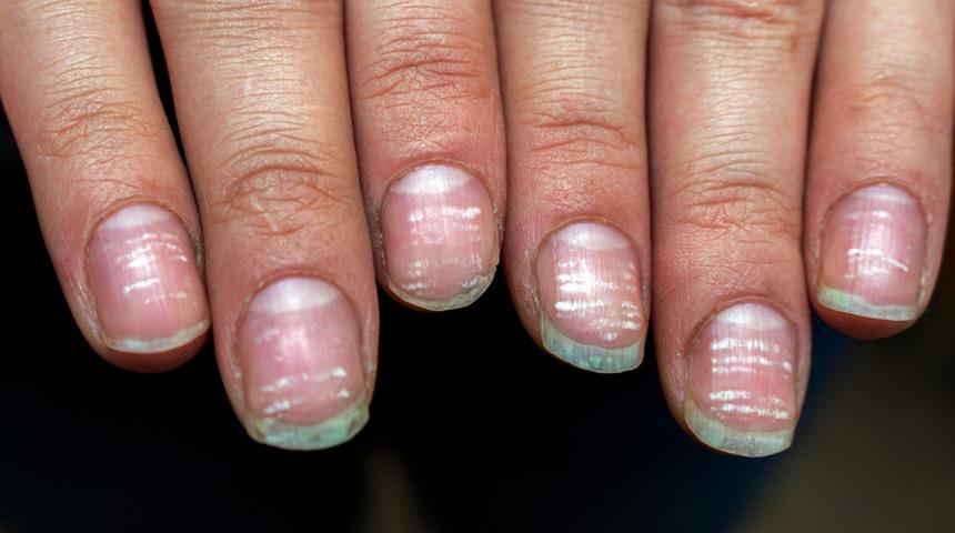 Tırnak lekesi deyip hafife almayın! Tırnak lekesinin altında çok önemli hastalıkların belirtileri olabilir...
