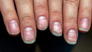 Tırnak lekesi deyip hafife almayın! Tırnak lekesinin altında çok önemli hastalıkların belirtileri olabilir...