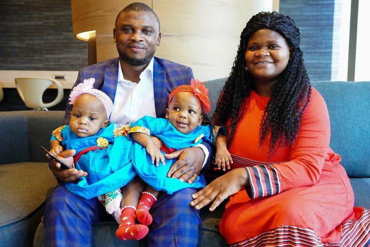 Kamerunlu yapışık ikizler 27 saat süren ameliyat sonrası sağlıklarına kavuştu! G2