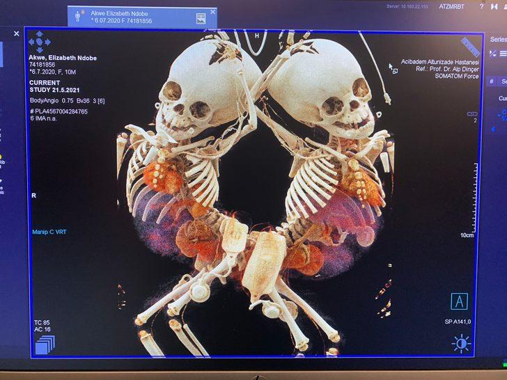 Kamerunlu yapışık ikizler 27 saat süren ameliyat sonrası sağlıklarına kavuştu! G1