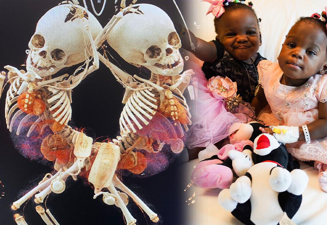 Kamerunlu yapışık ikizler 27 saat s&uuml;ren ameliyat sonrası sağlıklarına kavuştu!