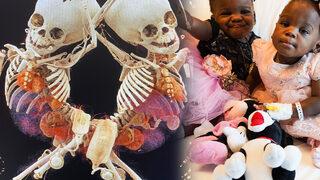 Kamerunlu yapışık ikizler 27 saat süren ameliyat sonrası sağlıklarına kavuştu!