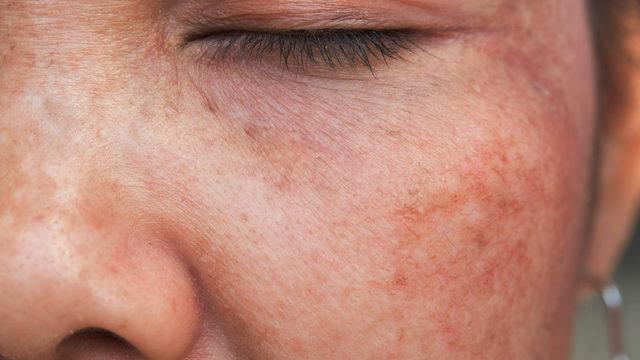 Cilt lekelerinin altındaki sebep belli oldu! İşte cilt lekelerine neden olan her şey