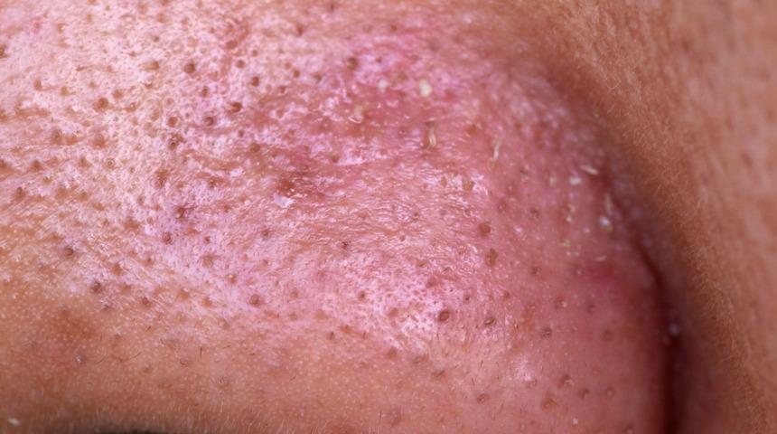 Siyah noktalardan tamamen kurtulabilirsiniz! Siyah nokta oluşumunu önlemek için...