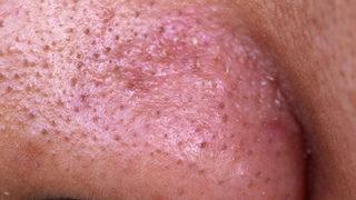 Siyah noktalardan tamamen kurtulabilirsiniz! Siyah nokta oluşumunu önlemek için...