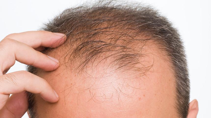 Saç dökülmesi nedenlerinin altında ciddi hastalıklar yatıyor olabilir!