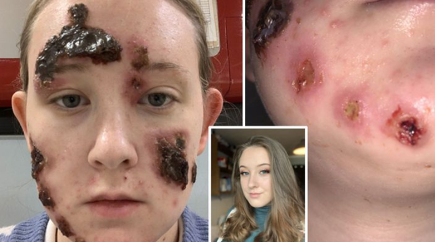 Dev et yiyen ülserleri yüzünü kapladı! Yaşadığı durum nedeniyle evden çıkamaz hale geldi