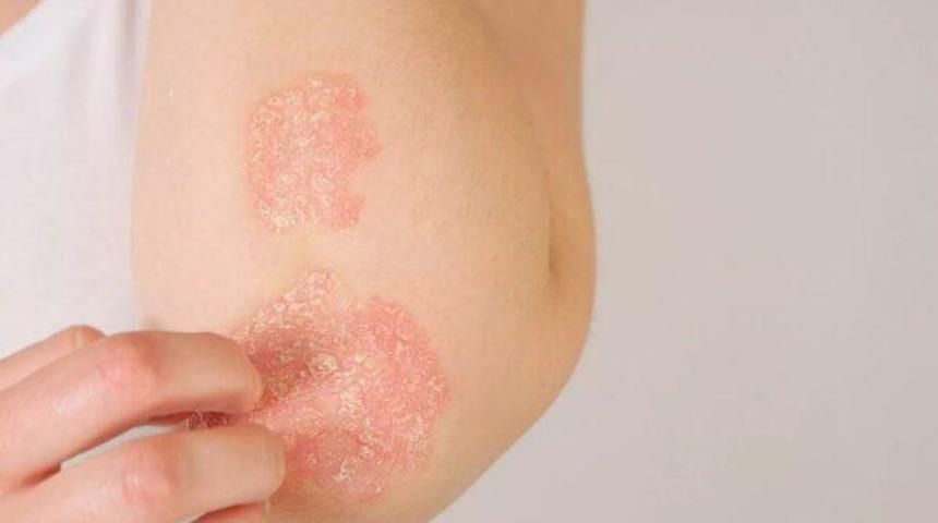 Sedef hastalığı kalp krizi riskini artırıyor