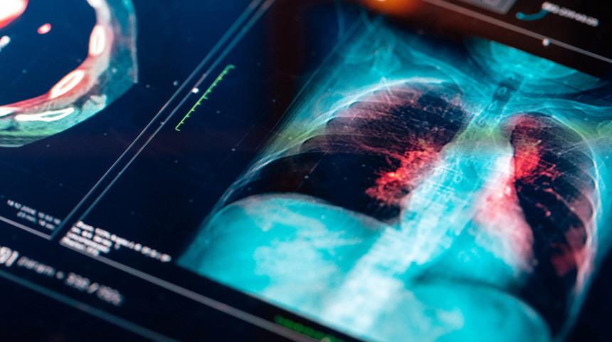 Akciğer kanseri belirti vermeden ilerliyor! Koronavirüs sanılıyor ama...