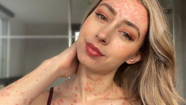 Sedef hastalığıyla kaplı vücudunu cesurca sergiledi! Güzellik kalıplarına meydan okudu