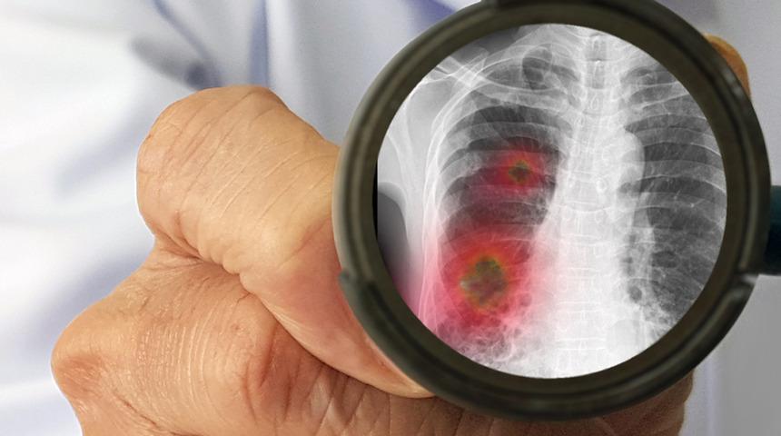 Zatürre tedavisi nasıl olur? Zatürreden korunmak için 8 öneri