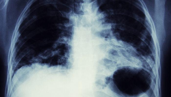 En çok hayati risk taşıyan tür: Akciğer kanseri belirtileri nelerdir?