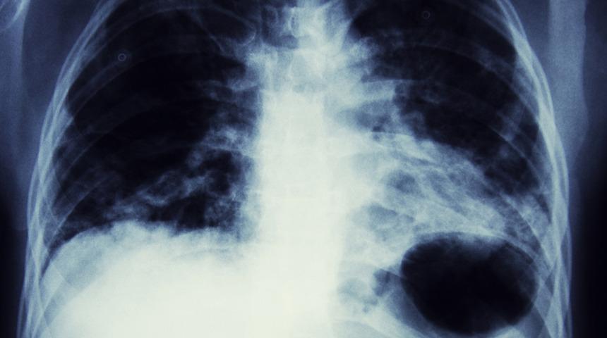 En çok hayati risk taşıyan tür: Akciğer kanseri belirtileri nelerdir? 