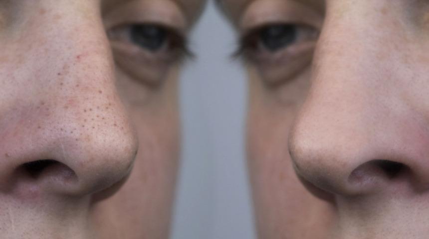 Ölü derilere elveda diyebilirsiniz! Evdeki malzemelerle yapabileceğiniz doğal peeling tarifleri