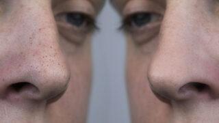 Ölü derilere elveda diyebilirsiniz! Evdeki malzemelerle yapabileceğiniz doğal peeling tarifleri