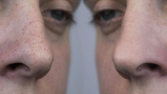 Ölü derilere elveda diyebilirsiniz! Evdeki malzemelerle yapabileceğiniz doğal peeling tarifleri