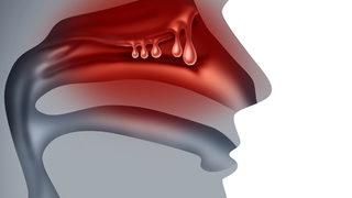 Burun ve sinüs iltihaplarının tekrarlamasıyla ortaya çıkan polip nedir? Baş ağrısına da neden oluyor