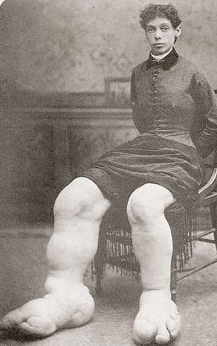 2 cinsel organı 3 bacağı olan şovmen! İşte tarihin en ilginç 5 insanı G2