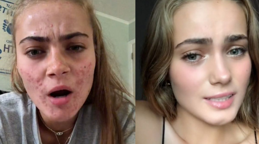 Yüzü aknelerle kaplıydı! Cilt bakımı rutini sayesinde bambaşka yüze kavuştu