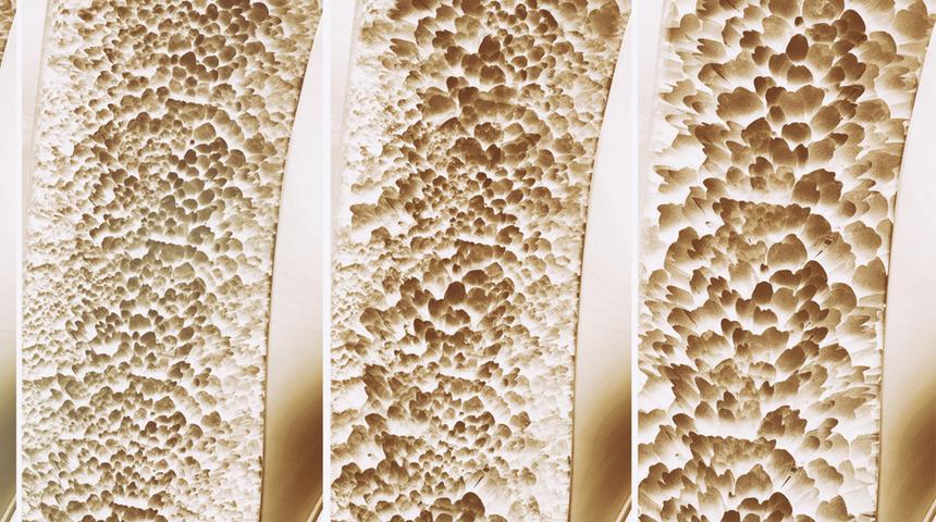 Osteoporoz belirtileri ve tedavisi nedir? Bu önlemler hastalığı engelliyor