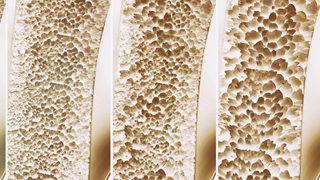 Osteoporoz belirtileri ve tedavisi nedir? Bu önlemler hastalığı engelliyor