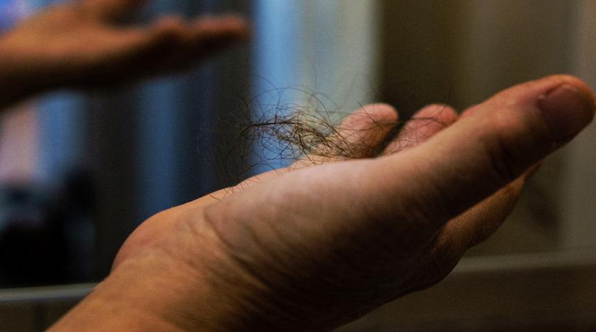 Saç dökülme nedenleri tedavi süresini de etkiliyor