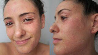 Hastalığı derisinin dökülmesine neden oluyor! Egzamayla mücadele eden sosyal medyada ilham veriyor