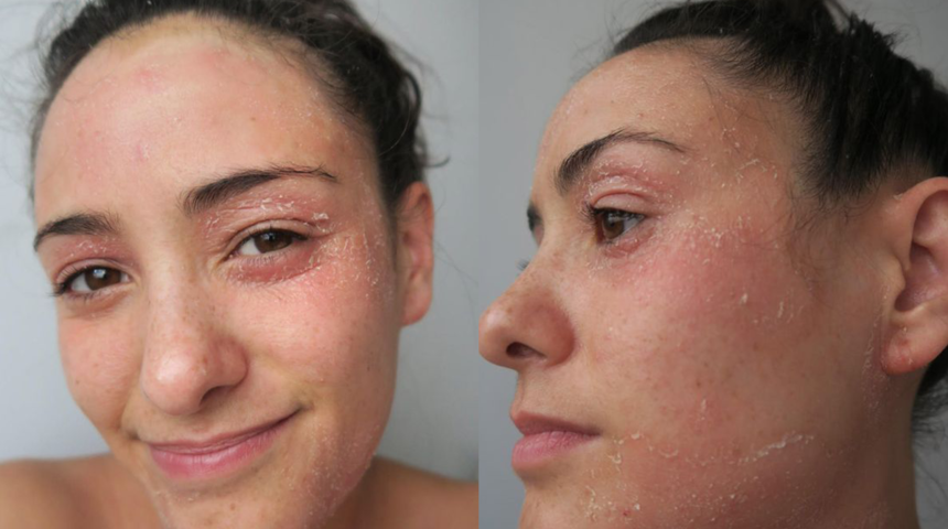 Hastalığı derisinin dökülmesine neden oluyor! Egzamayla mücadele eden sosyal medyada ilham veriyor