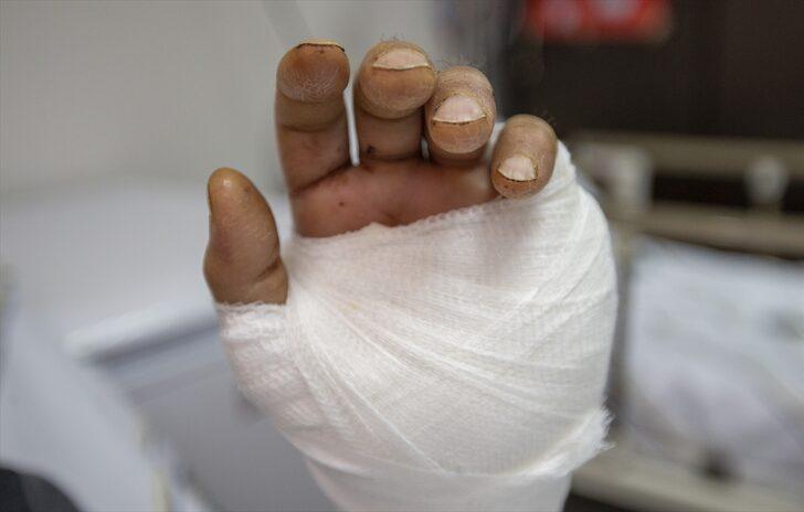 İş kazasında kopan eli doktorların zamanla yarışıyla yerine dikildi G1