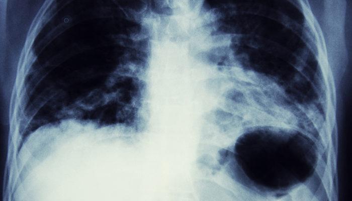 Akciğer kanseri tedavisinde 3 önemli gelişme! Yaşam süresini uzatıyor