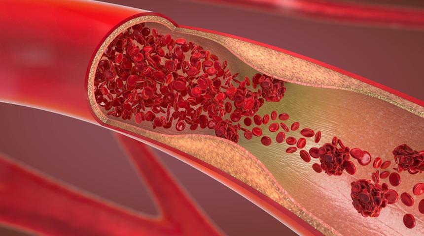 Bypass nedir, neden yapılır? Bypass izi kalıcı mıdır? İşte en çok merak edilen sorular