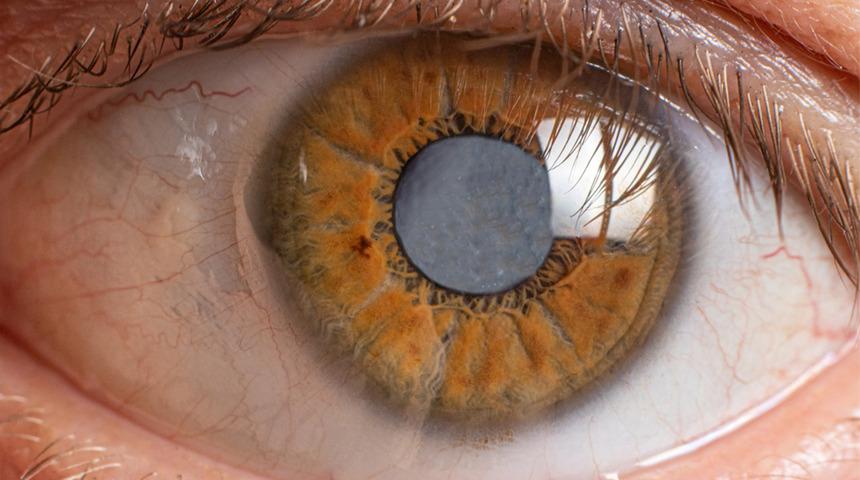 Pandemiyle artış gösteren miyopi kalıcı körlük nedeni! "Günde 2 saat aydınlık havada gezin" önerisi