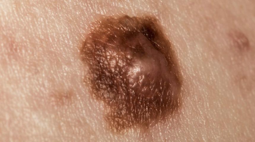 Vücutta hızla yayılıyorsa dikkat! Benlerle ilgili yanlış bilgi sağlığınızdan edebilir