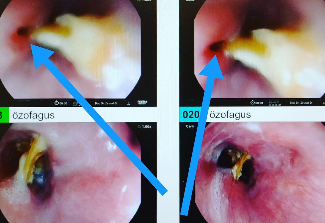 Yediği turpun yemek borusunu deldiğini sandı, ger&ccedil;ek bambaşka &ccedil;ıktı!