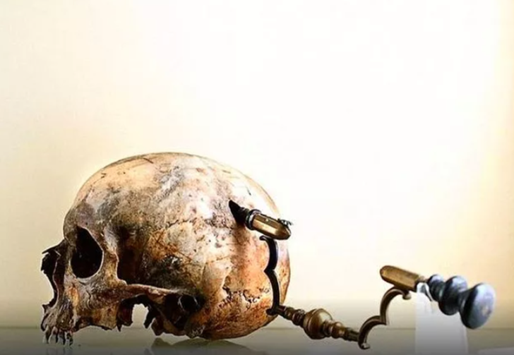Tarihin en eski cerrahi yöntemi! Antik Çağlarda kullanılan bir ameliyat prosedürü: Trepanasyon
