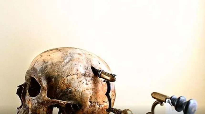 Tarihin en eski cerrahi yöntemi! Antik Çağlarda kullanılan bir ameliyat prosedürü: Trepanasyon