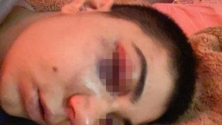 Taksim'de dehşeti yaşadı! Yabancı uyruklu şahıstan genç kızı felç eden dayak: Ameliyata girersek elimde kalırsın