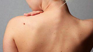 Benler kanserin habercisi