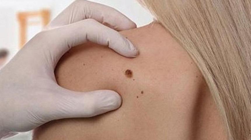 Fazla bende kanser riski