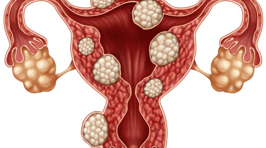 V-Notes yöntemi miyom tedavisi ameliyatında izsiz ve ağrısız sonuç almayı sağlıyor